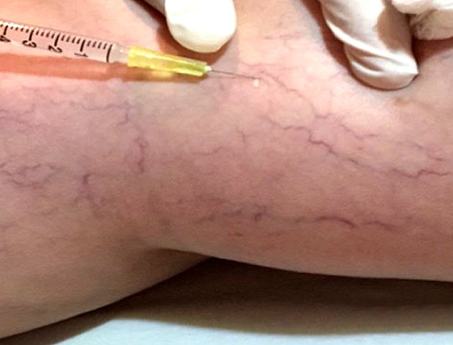 Tratamento de Microvasos nas Pernas: Fundamentos Científicos, Benefícios Estéticos e Impacto na Autoestima