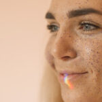 MANCHAS HIPERPIGMENTARES