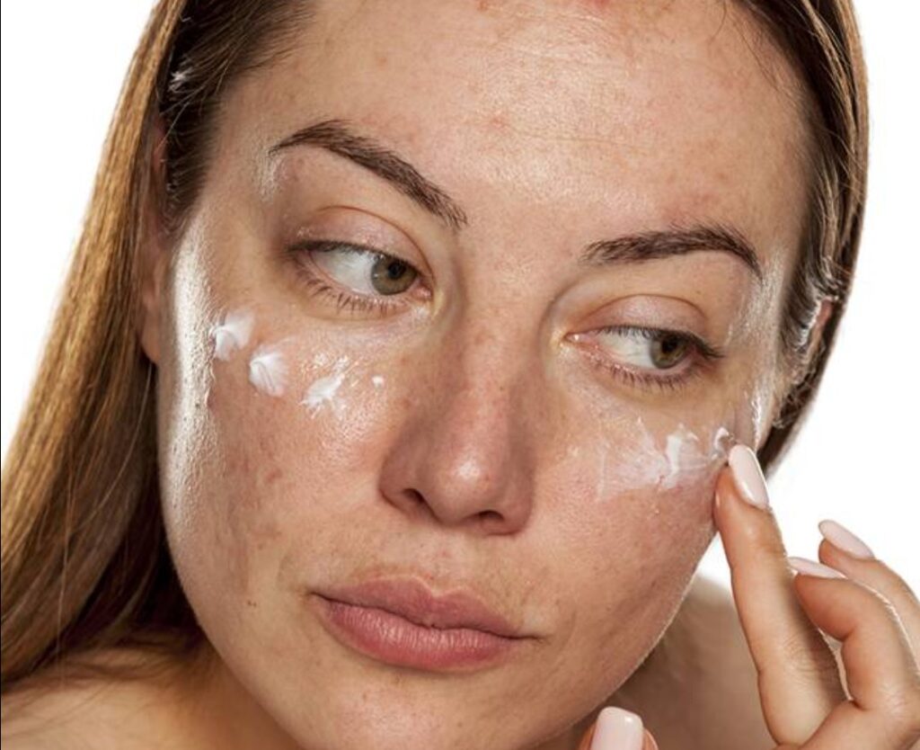 ativos-clareadores-para-melasma