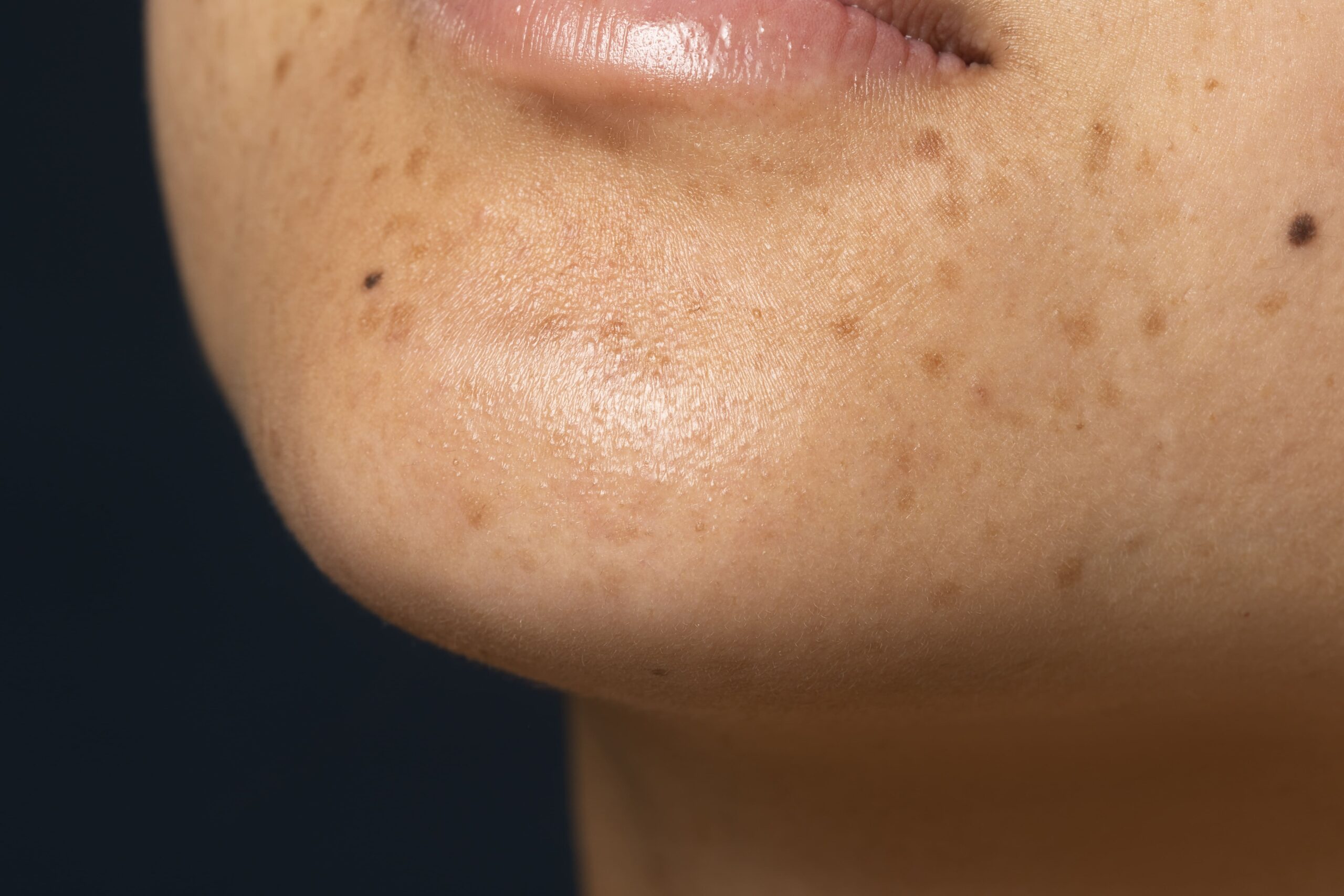 melasma profundo