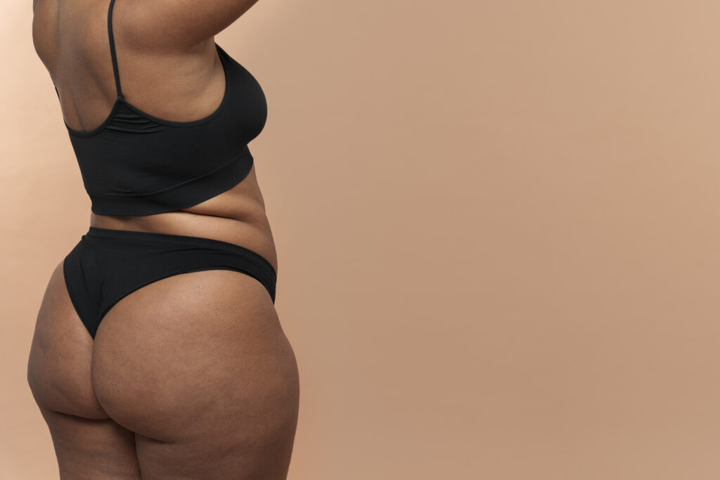 o que é celulite e como ela aparece nas coxas