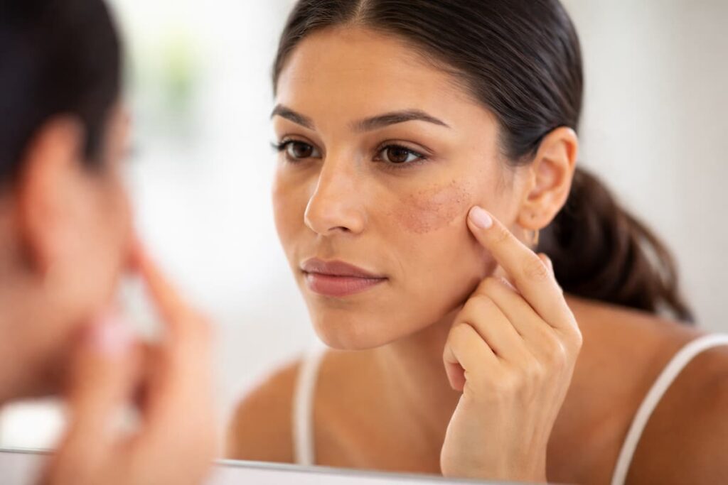 o que piora o melasma - Mulher observando manchas de melasma no rosto no espelho, destacando hiperpigmentação na pele