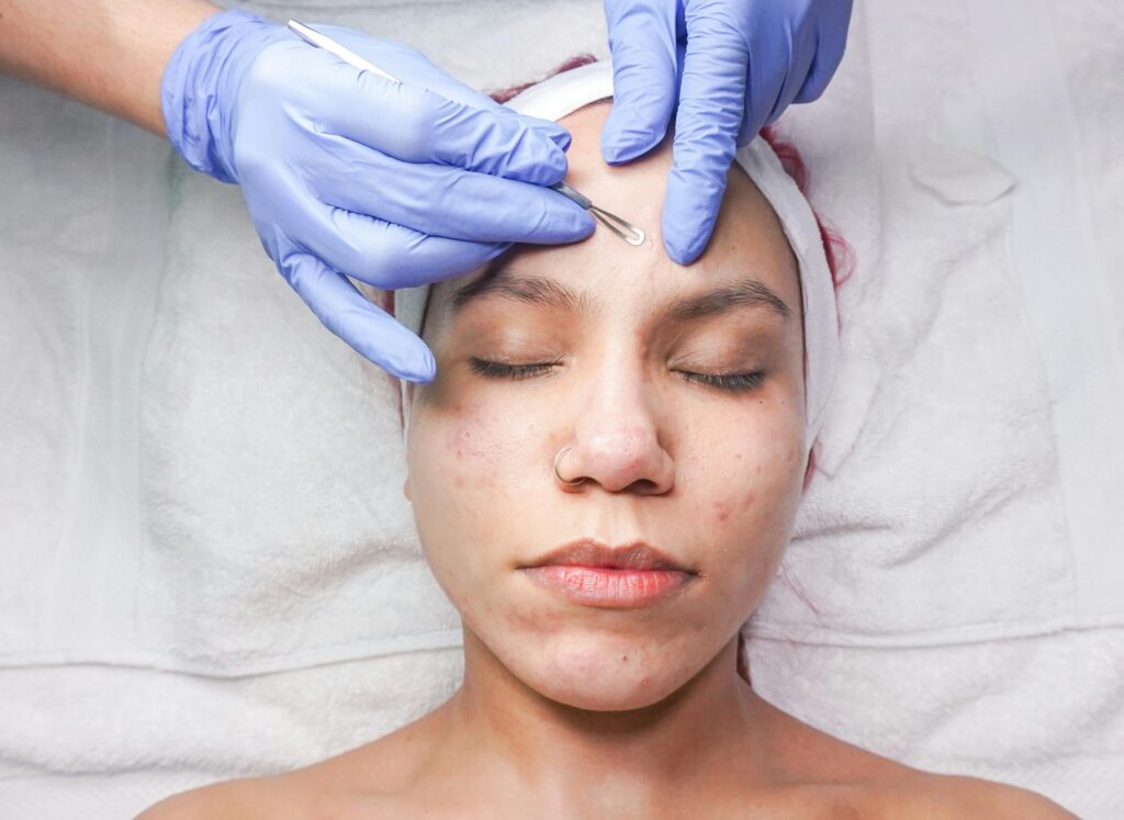 Como acabar com a acne: cuidados com a pele acneica e tratamento eficaz