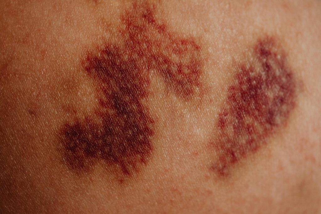 Detailed close-up of a bruise on skin showing purplish discoloration and texture.