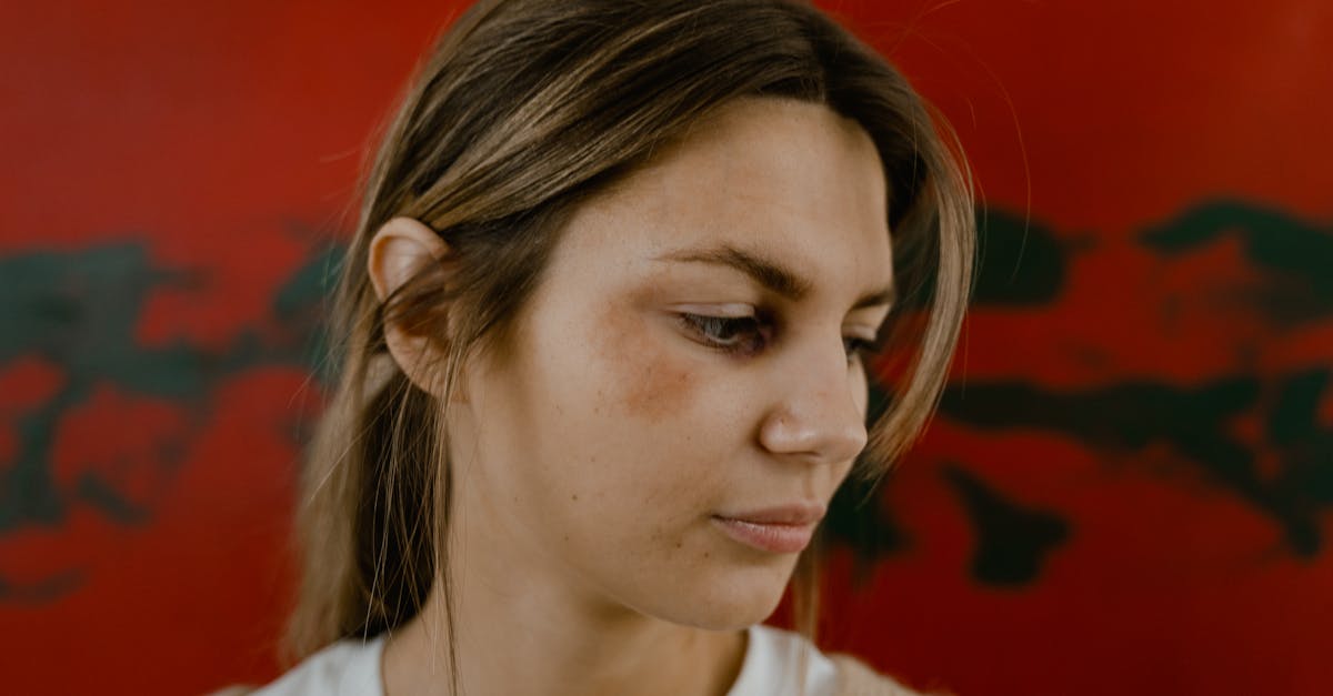 Melasma tem cura? Veja o que dizem os dermatologistas