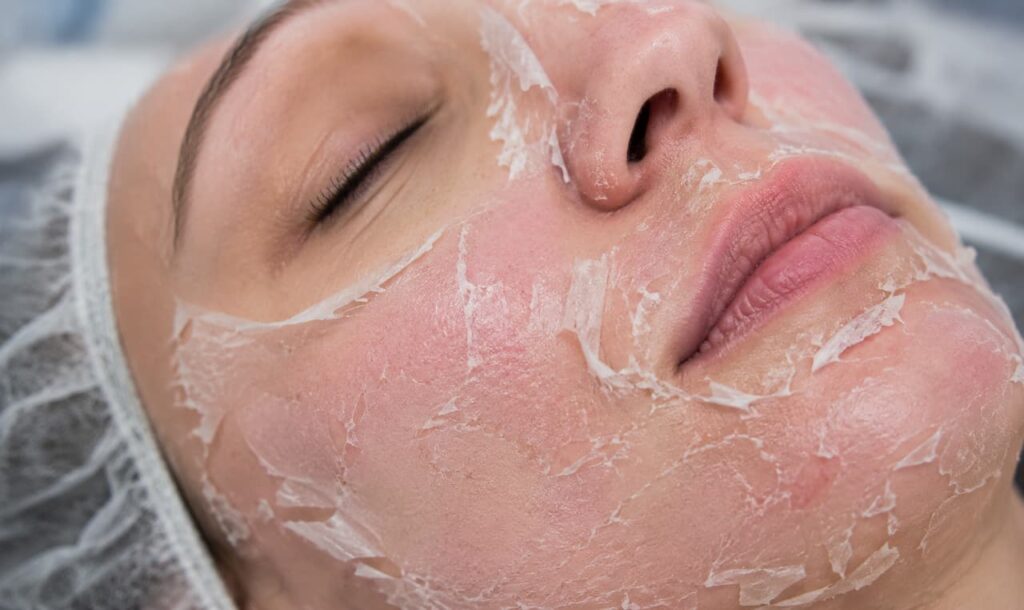 peeling-quimico-para-manchas-funciona