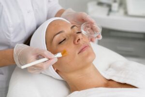 Os 5 Melhores Peelings para Melasma: Benefícios, Indicações e Cuidados