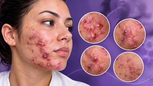 Acne Fulminante: o Que É, Sintomas, Causas e Como Deve Ser Tratada